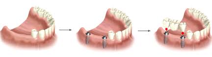 implantologia dentale